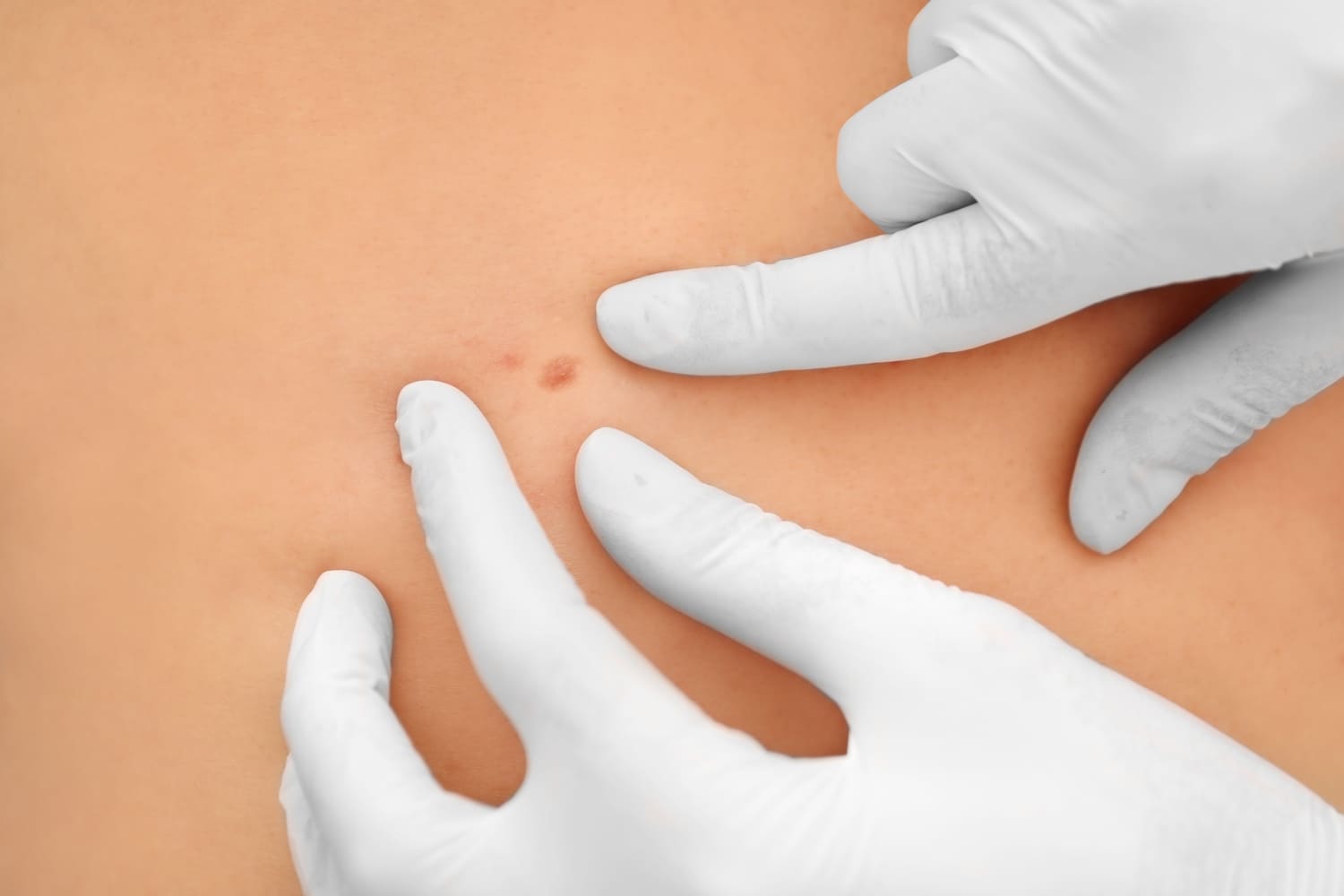 Verrugas en CDMX - Diagnóstico y Tratamiento en Safe Care